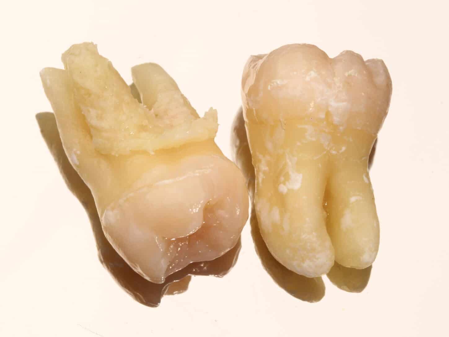 nhổ răng khôn giá bao nhiêu