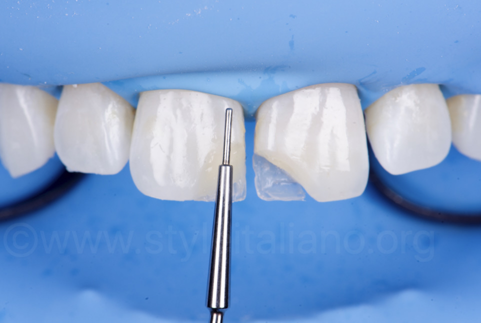 Trám răng thẩm mỹ đòi hỏi vật liệu tốt và tay nghề cao