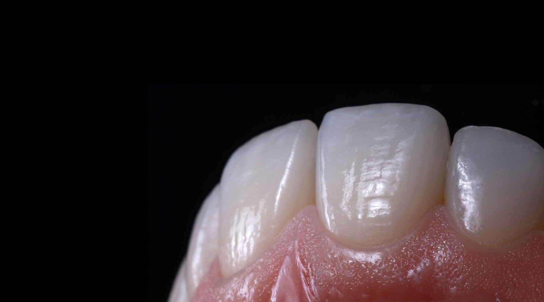 trám răng thẩm mỹ