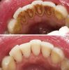 Có cần đánh bóng răng sau khi lấy vôi răng không? Lợi ích gì?