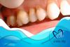 Khuyết cổ răng nguy hiểm tiềm tàng